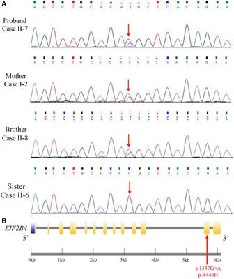 Identification of a Novel Heterozygous Mutation in the EIF2B4 Gene Associated With Vanishing White Matter Disease